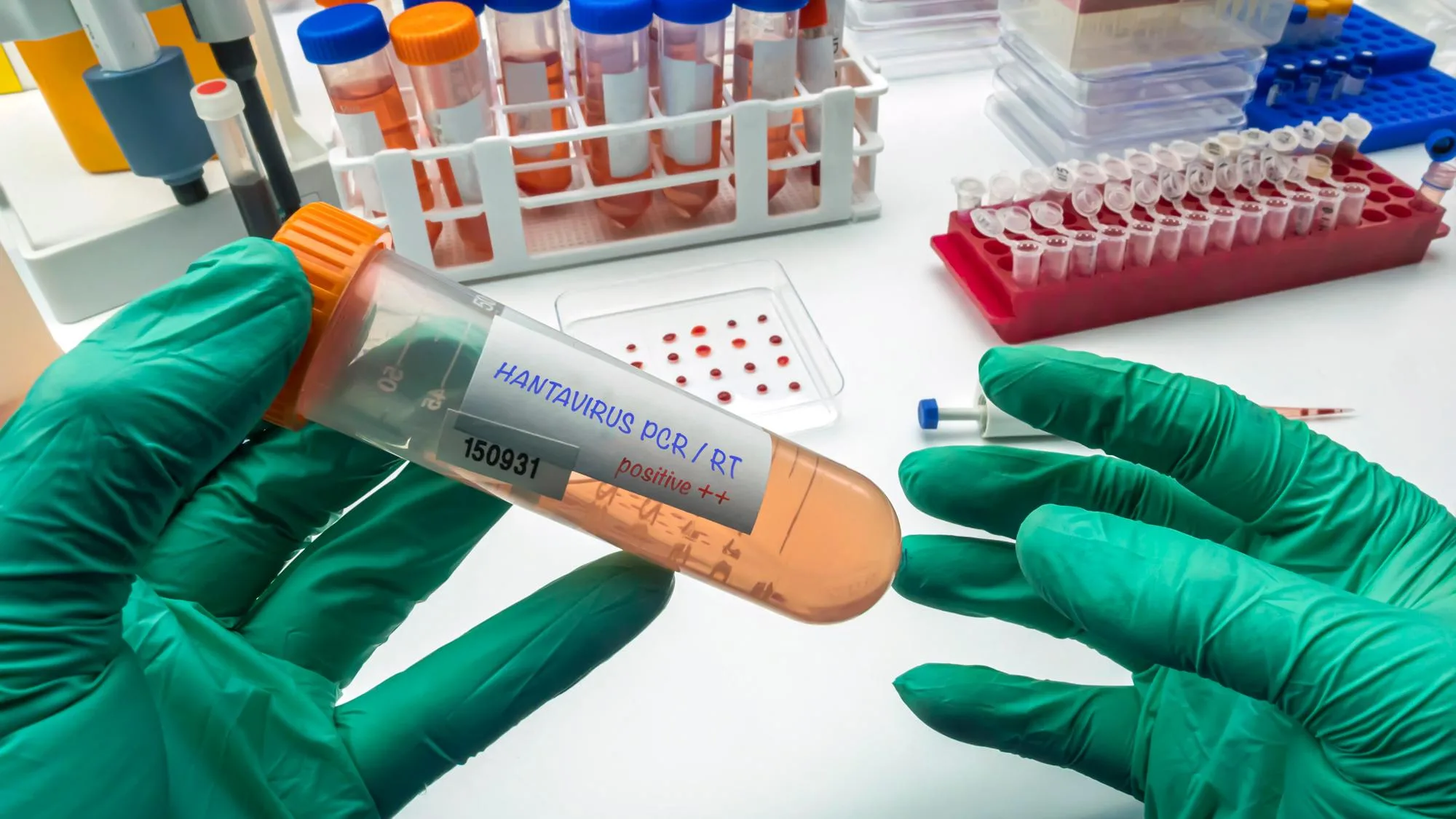 UN NOUVEAU CAS DE HANTAVIRUS SIGNALÉ PAR LE ROYAUME-UNI, UN MOIS APRÈS LA PANIQUE MONDIALE