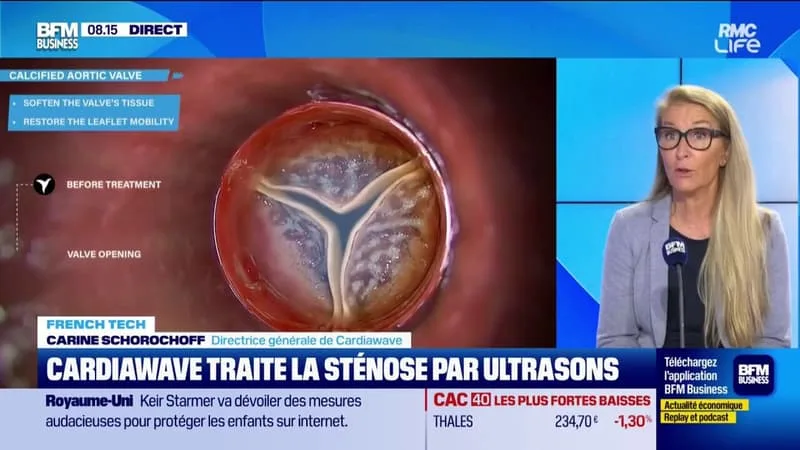 CARDIAWAVE TRAITE LA STÉNOSE PAR ULTRASONS